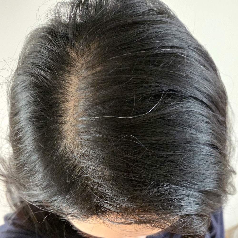 40대 여성 탈모, 미용실 원장님 한마디에 병원까지 다녀왔어요 (여성 탈모약 처방 후기)